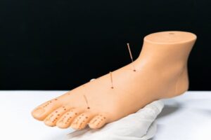 How to become an acupuncturist